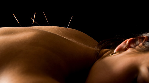 Traditional Chinese Medicine and Acupuncture